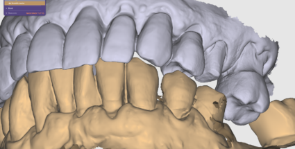 laboratorio-zaramella-scansione-intraorale